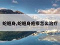 蛇缠身,蛇缠身疱疹怎么治疗